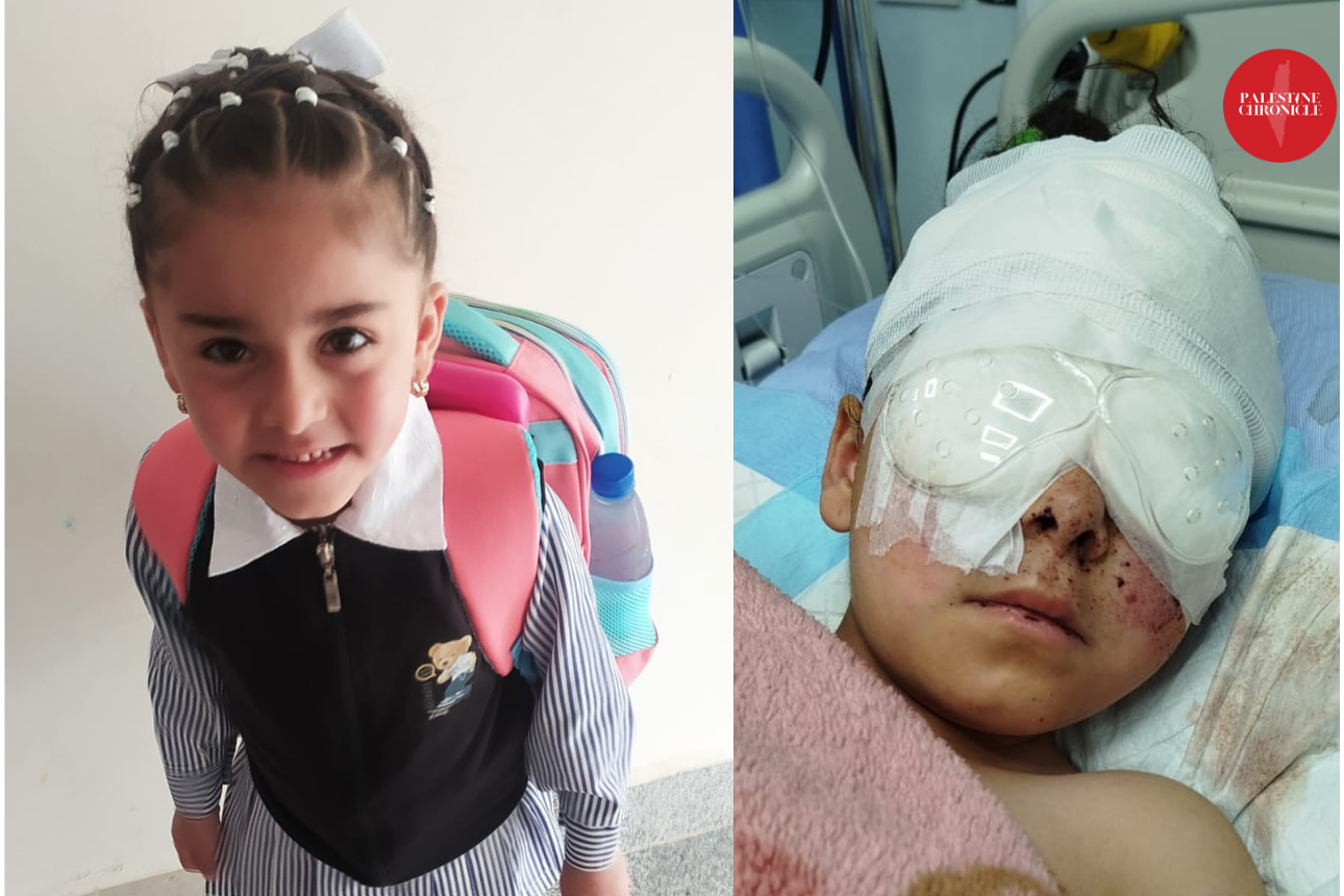 Blinded in Hebron – Israel Shot Jannat in the Face and the Media Ignored It