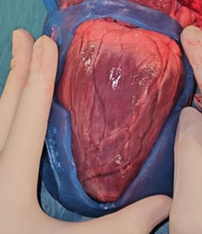 Development of a patient-specific epicardial guide for ventricular tachycardia ablation surgery using high-consistency rubber silicone molding | BioMedical Engineering OnLine