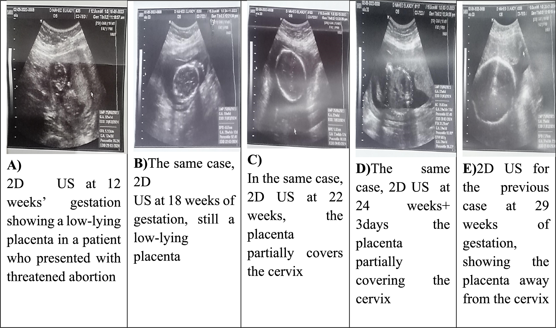 Placental adhesions diagnosis in the first trimester of pregnancy by using three-dimensional (3D) ultrasound and color Doppler | Egyptian Journal of Radiology and Nuclear Medicine