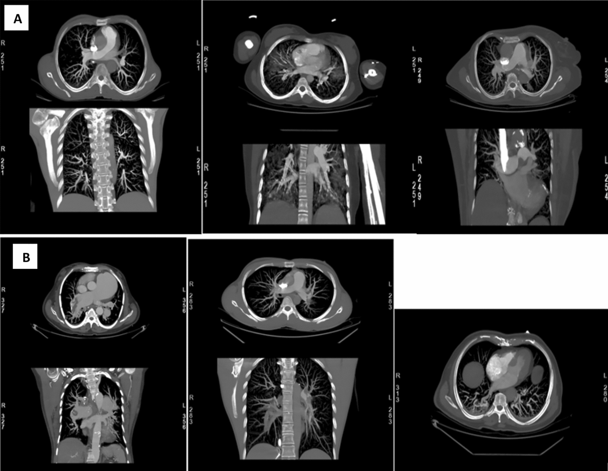 Optimizing CT pulmonary angiography: comparison of radiation dose, contrast volume, and image quality between standard and low-dose protocols | Egyptian Journal of Radiology and Nuclear Medicine