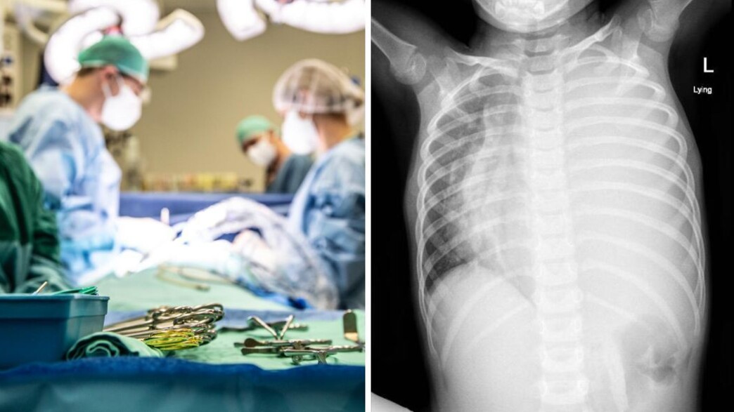 בת 4 עברה ניתוח להסרת גידול עצום