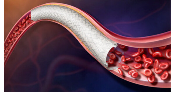 BD Achieves Milestone in AGILITY Study of Revello™ Vascular Covered Stent for Treatment of Peripheral Artery Disease
