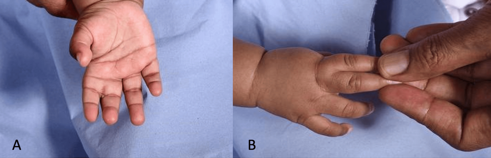Use of Adjunct Oral Methotrexate in the Management of Keloid Formation Following Syndactyly Revision Surgery: A Case Report and Review of the Literature