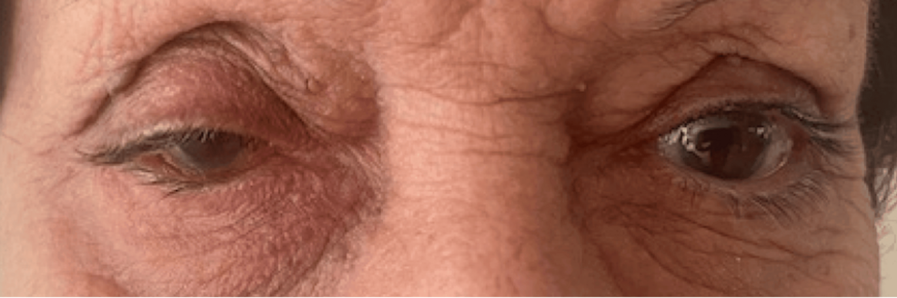 Rituximab-Based Management of Autoimmune Blistering Diseases: A Case Series Highlighting Ocular and Systemic Presentations