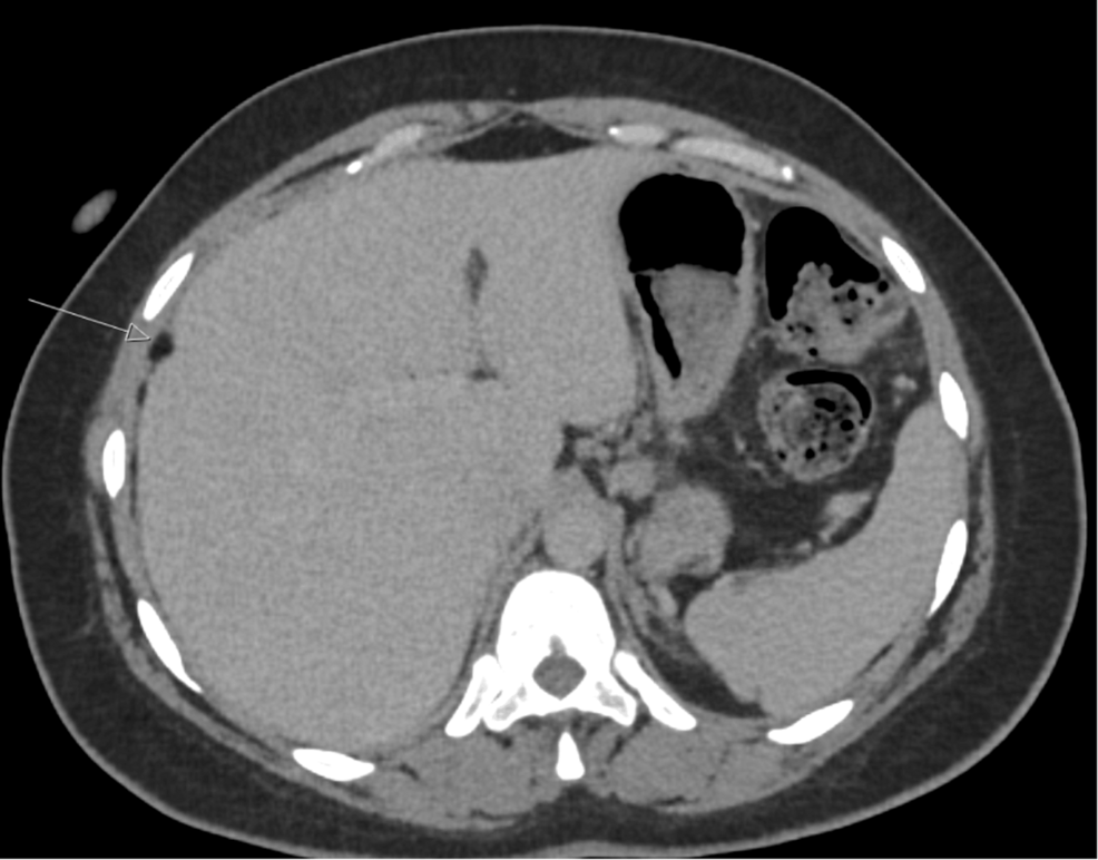 Multimodality Imaging of a Ruptured Ovarian Dermoid Cyst Presenting As Disseminated Granulomatous Inflammation: A Radiology Case Report