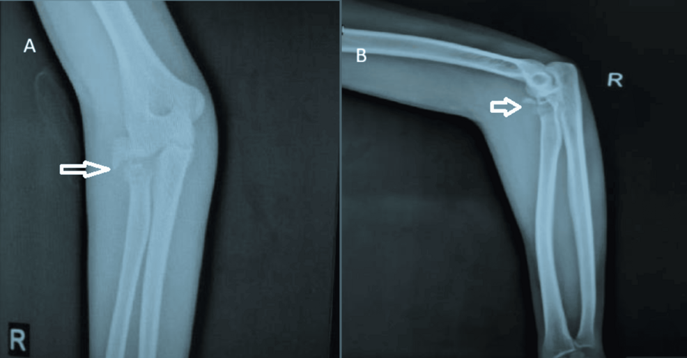 Early Functional and Radiological Outcomes of Radial Head Replacement in the Management of Radial Head Fractures: A Prospective Study