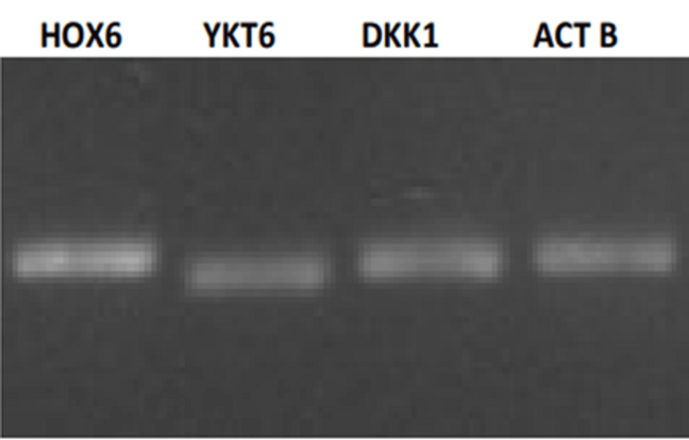 Expression of DKK1, HOXC6, and YKT6 Genes in Subjects With Oral Squamous Cell Carcinoma Residing in Central India: A Case-Control Study
