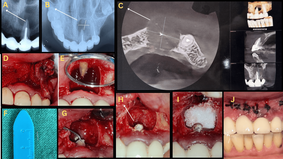 Surgical Management of a Separated Instrument and Radicular Cyst: A Nine-Month Cone Beam Computed Tomography (CBCT) Follow-up