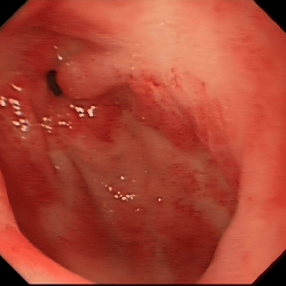 Gastric Antral Vascular Ectasia Preceding the Diagnosis of Limited Cutaneous Systemic Sclerosis