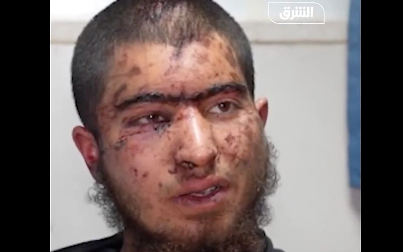 From hospital, severely hurt 18-year-old Palestinian describes beating by settlers near Ramallah