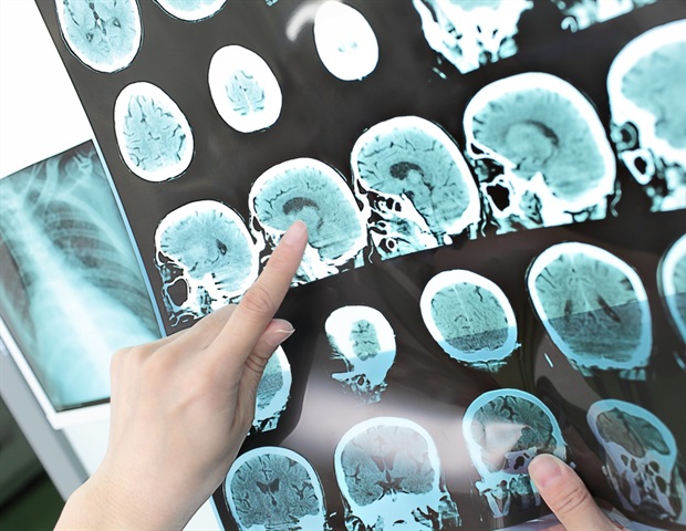 Breakthrough in imaging speed moves portable stroke diagnosis closer to reality