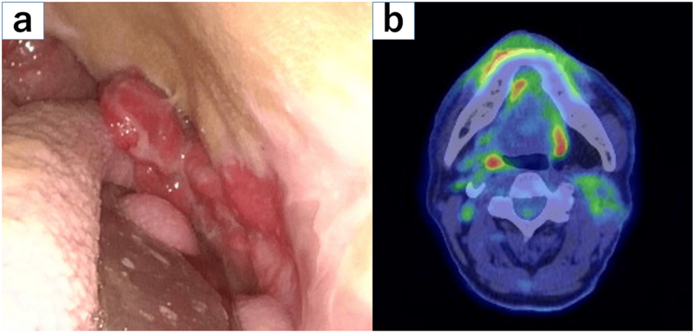 A Novel Intensity-Modulated Radiation Therapy Approach to Reduce Tongue Radiation Dose Using the BinkieRT Intraoral Device: A Case Report