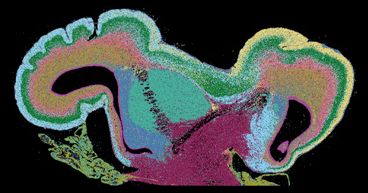 Among brain changes studied in autism, spotlight shifts to subcortex