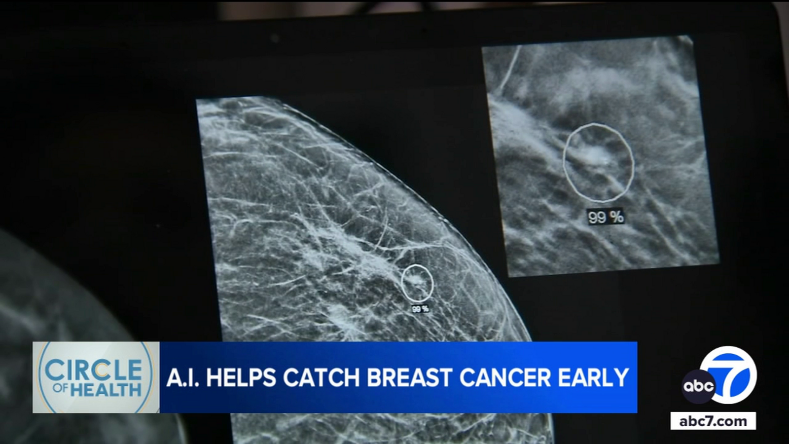 Radiologists at Providence St. Joseph Hospital in Orange County use AI to detect breast cancer earlier