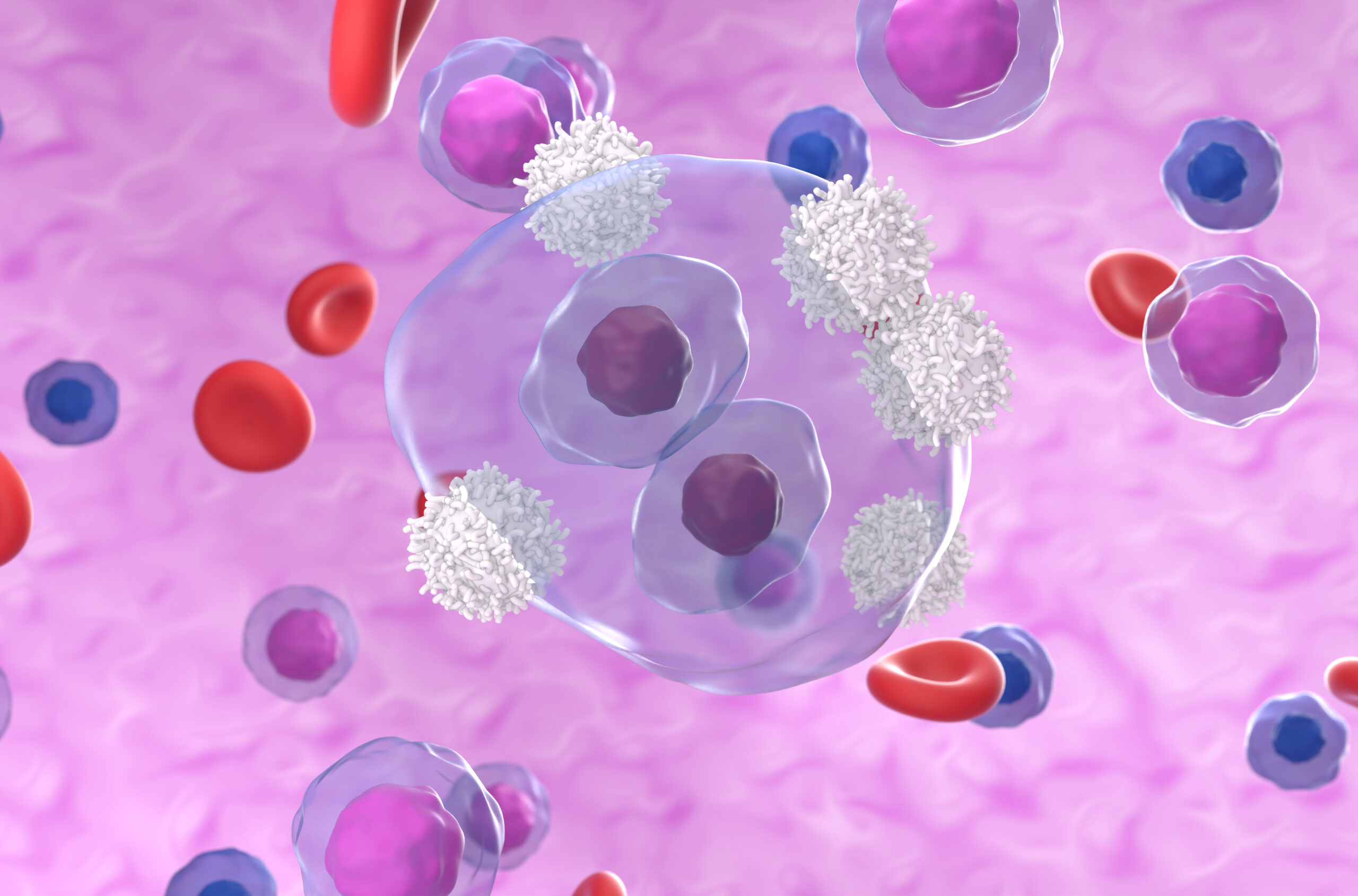 Nivolumab Plus AVD Reduces Disease Progression Risk in Advanced Classical Hodgkin Lymphoma