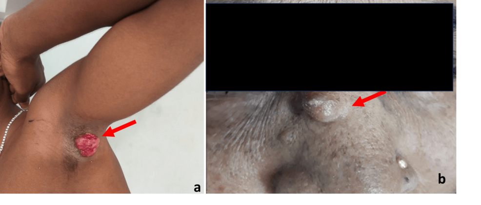 Clinicopathological Profile and Diagnostic Concordance of Skin Adnexal Tumours at a Tertiary Care Centre