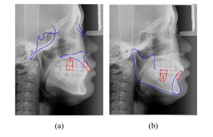 Reliability assessment of the non-rigid registration for central incisors movement evaluation based on CBCT registration