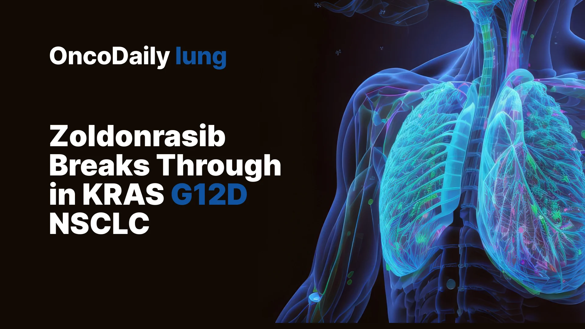 Zoldonrasib Shows Early Strength in Previously Treated KRAS G12D NSCLC